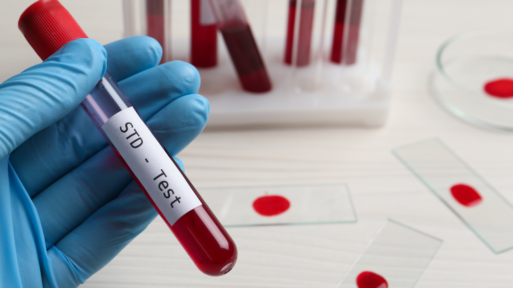 L'Importance du Dépistage des Infections Sexuellement Transmissibles