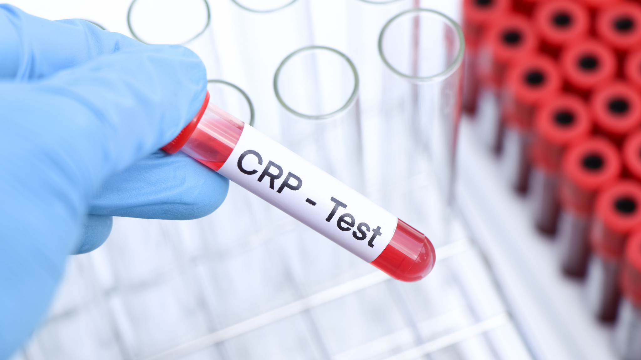 La Protéine C Réactive (CRP) : Un Indicateur Clé de l’Inflammation dans Votre Corps